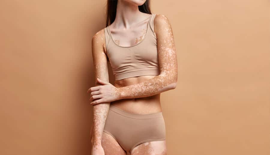 corpo de mulher com vitiligo.